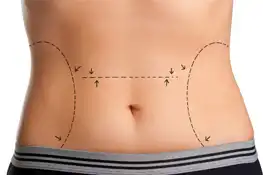 Fat Loss Surgery  in Chhattisgarh