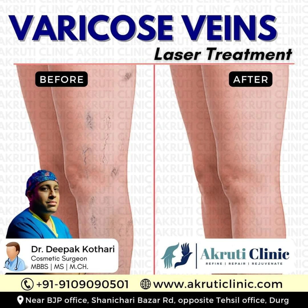 Varicose Veins Treatment in Chhattisgarh