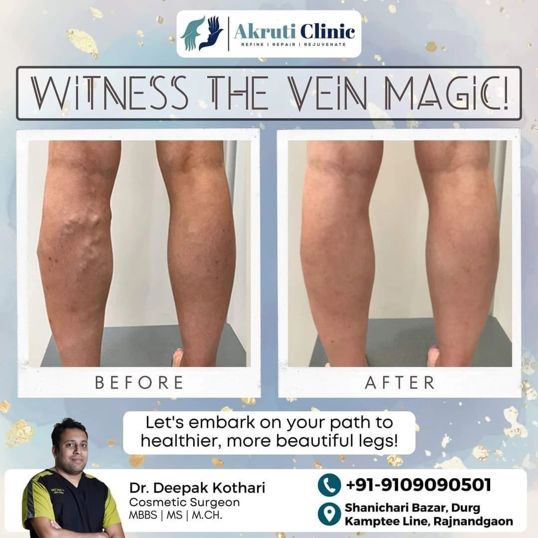 Varicose Veins Treatment in Chhattisgarh